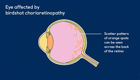 new treatment for birdshot chorioretinopathy.